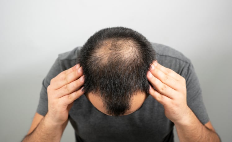 Man showing damaged scalp hair