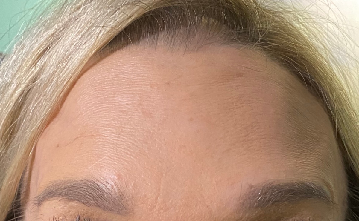 Client forehead after BOTOX®