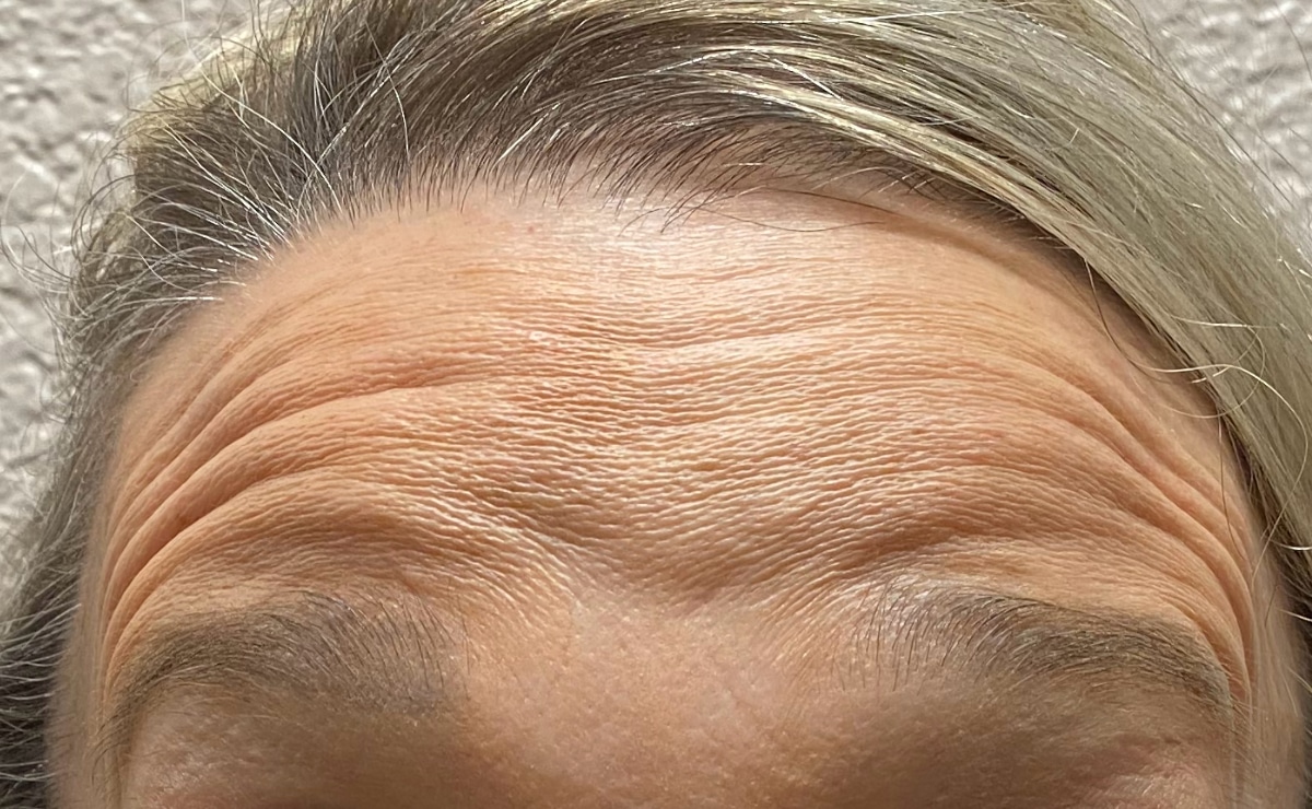 Client forehead before BOTOX®