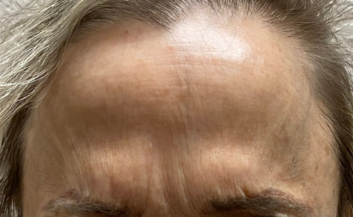 Client forehead after BOTOX®