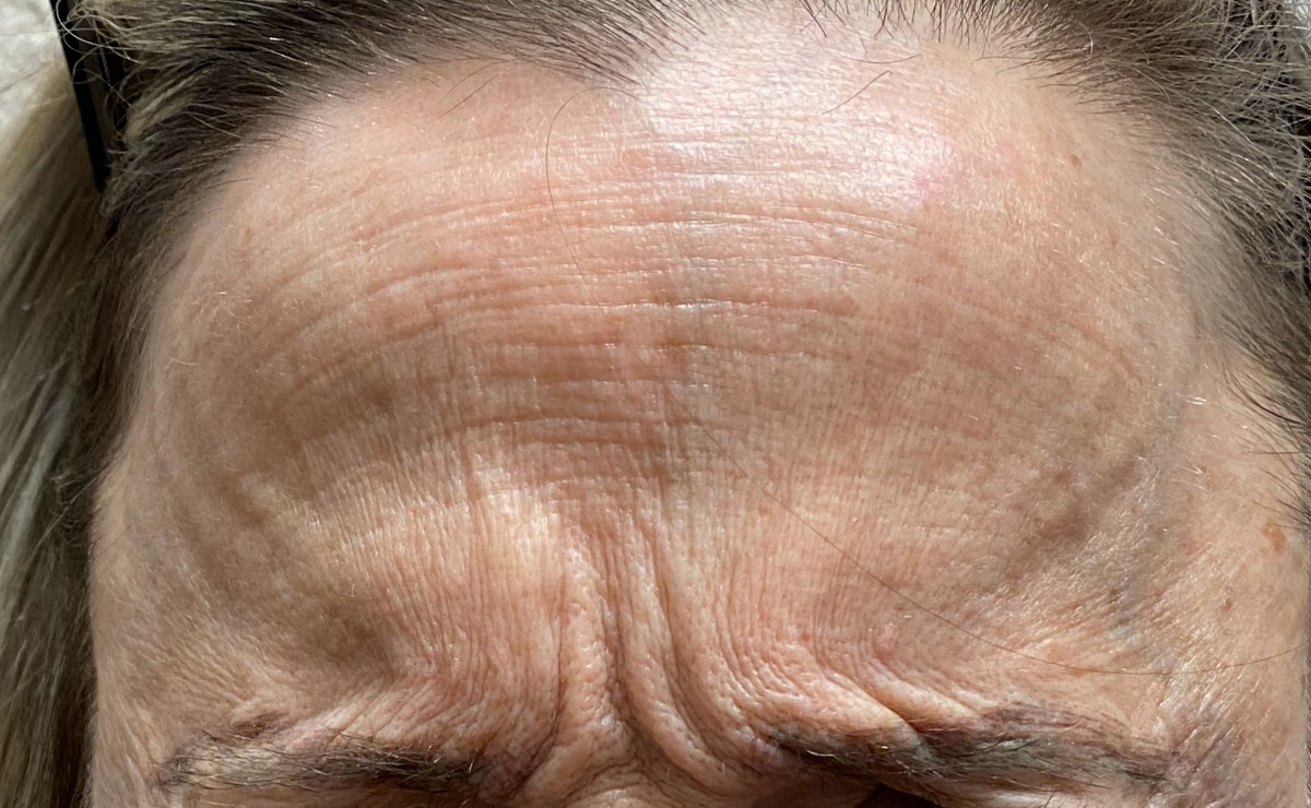 Client forehead before BOTOX®