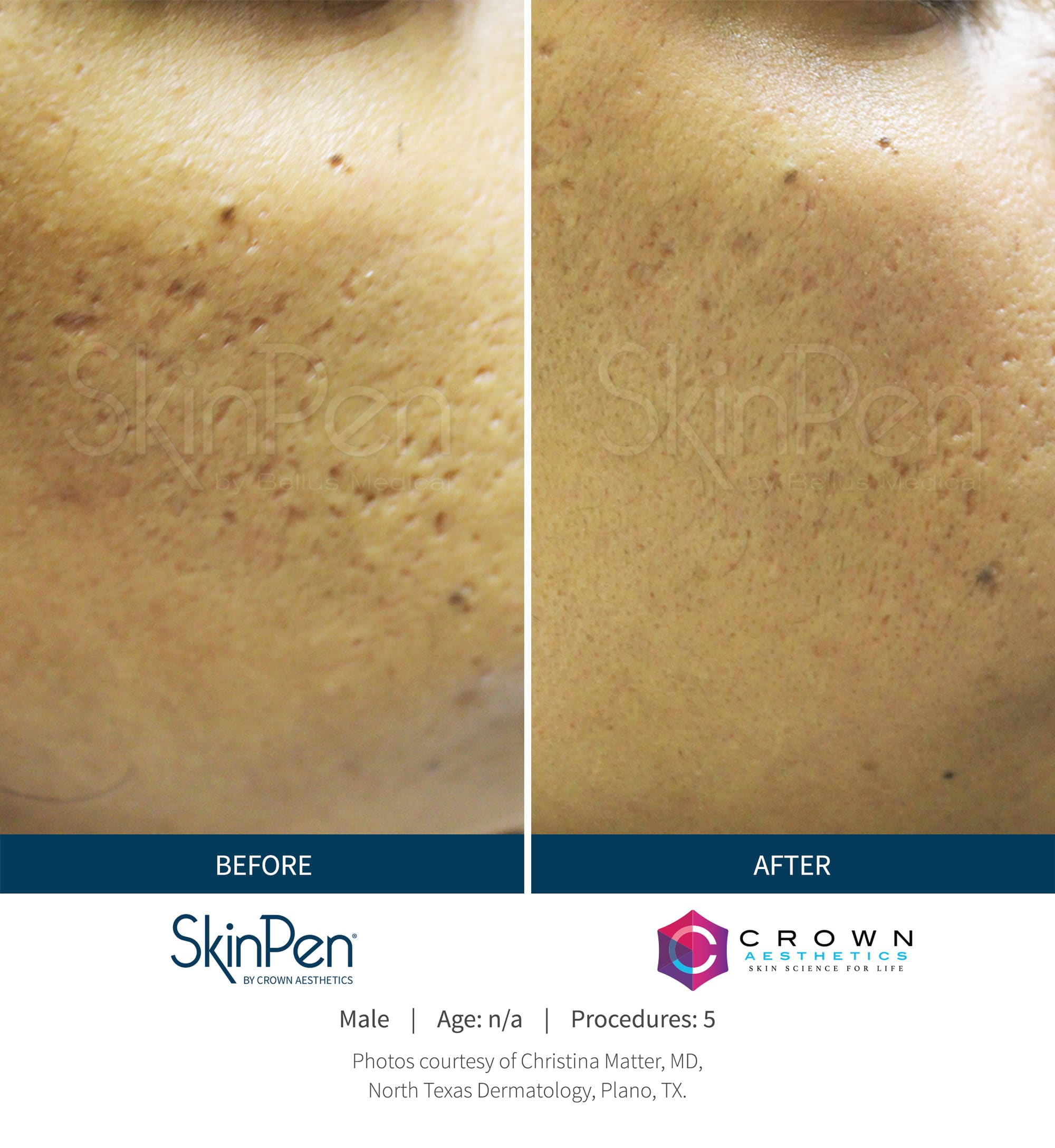 SkinPen used on patient for microneedling